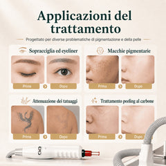 LASER FacialPure 4.0, Macchina Portatile Picosecondi Non Invasiva Con Trolley Piccolo, Rimozione Tatuaggi E Depilazione Sopracciglia