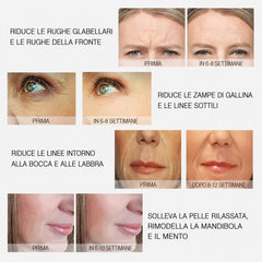 MLAY Macchina professionale di bellezza a radiofrequenza per lifting, tonificazione, rimozione delle rughe, rassodamento della pelle del viso e del corpo
