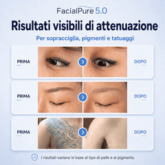 LASER FacialPure 5.0 – Macchina Laser Picosecondi Portatile in Elegante Valigetta Nera per Rimozione Indolore e Non Invasiva di Tatuaggi e Sopracciglia